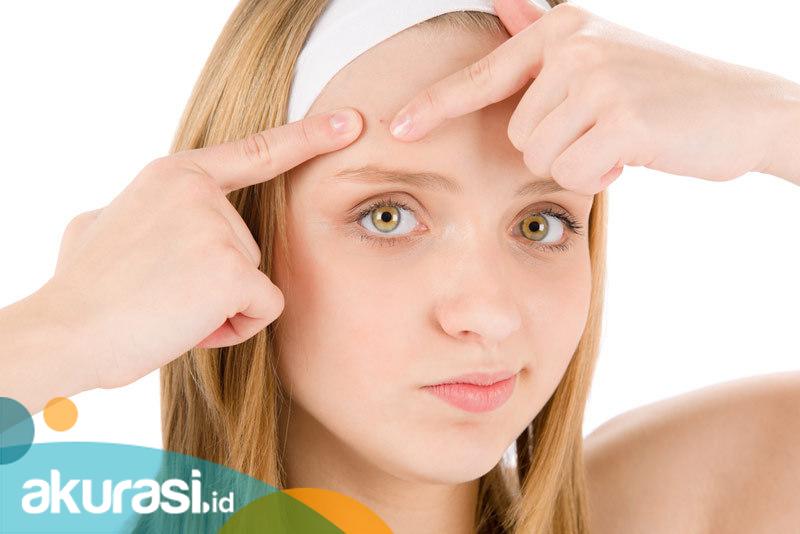 Bisa Bikin Depresi dan Bunuh Diri, Bagaimana Cara Aman Atasi Jerawat ?